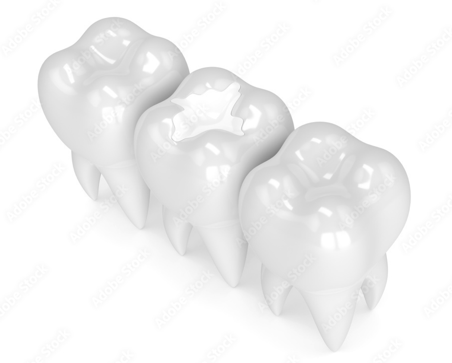 Teeth Showing Restoration of Enamel