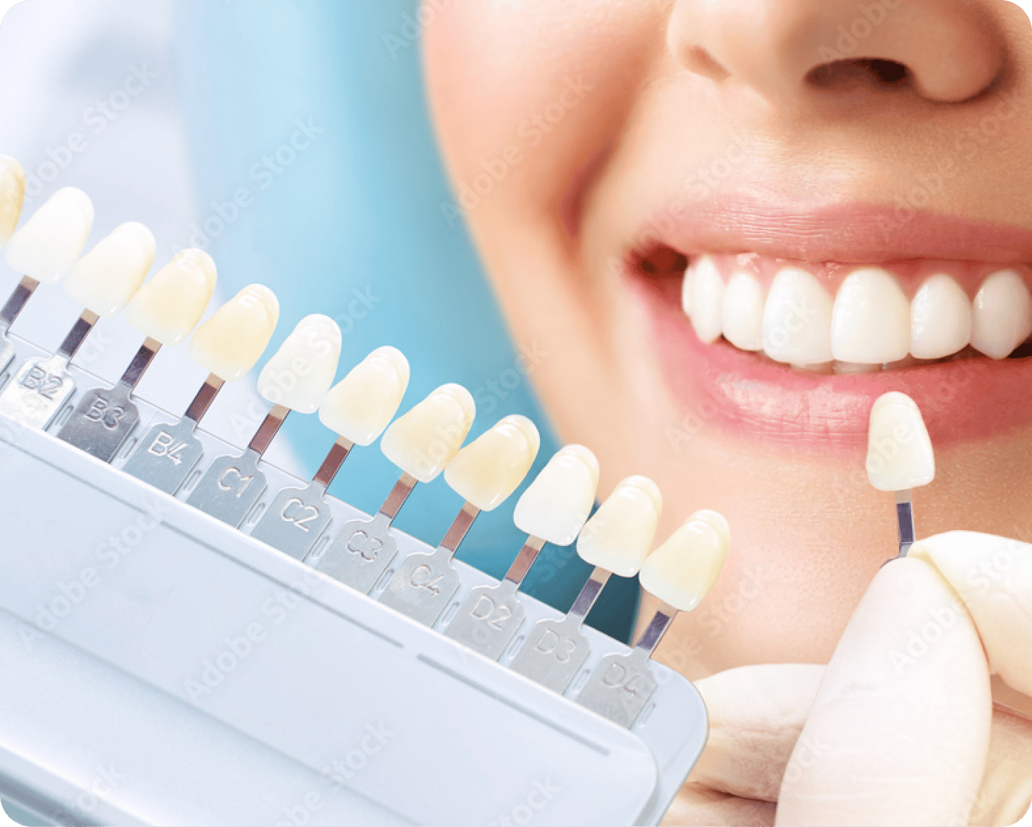 Tooth colour matching for Cosmetic Dentistry